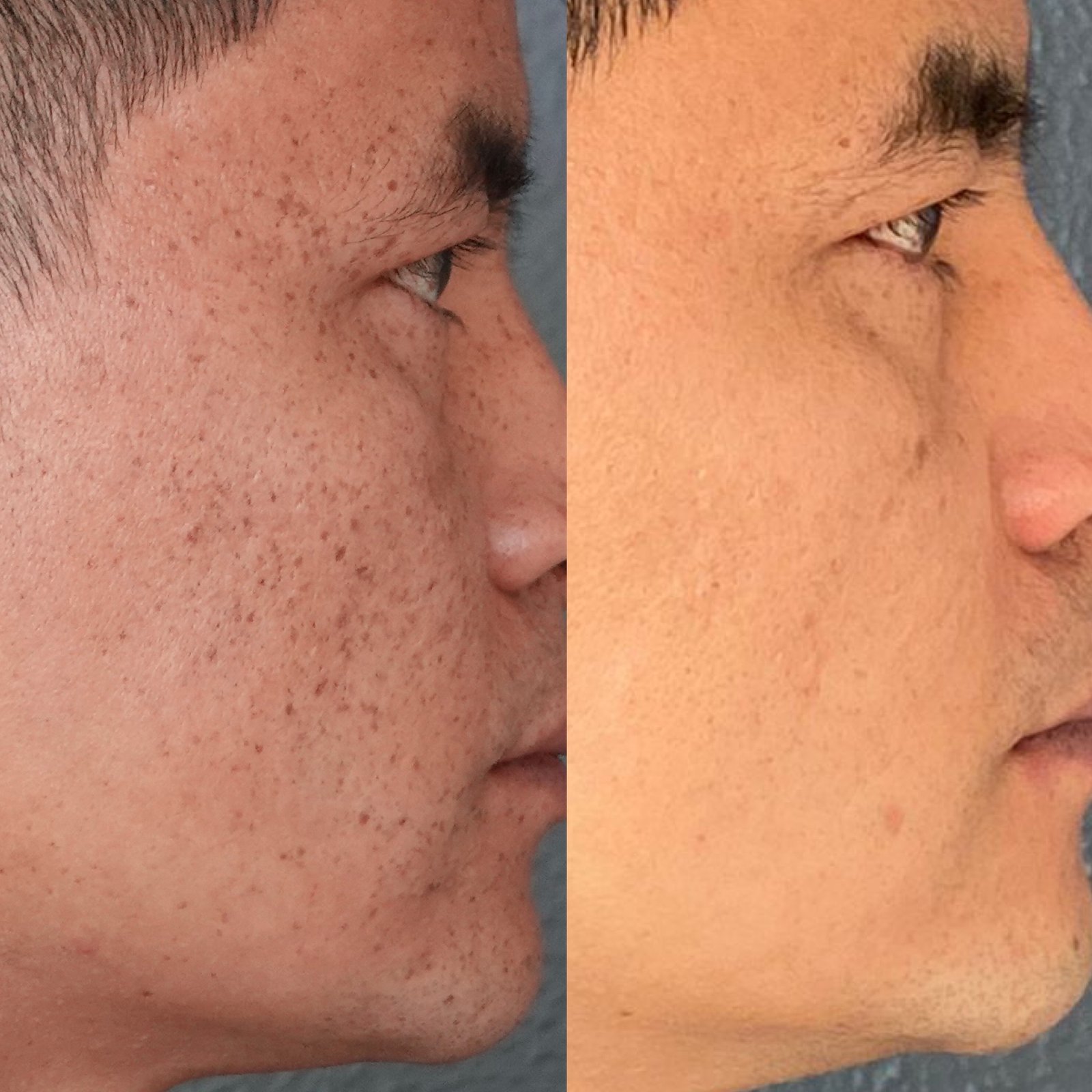 Freckle Removal Results
