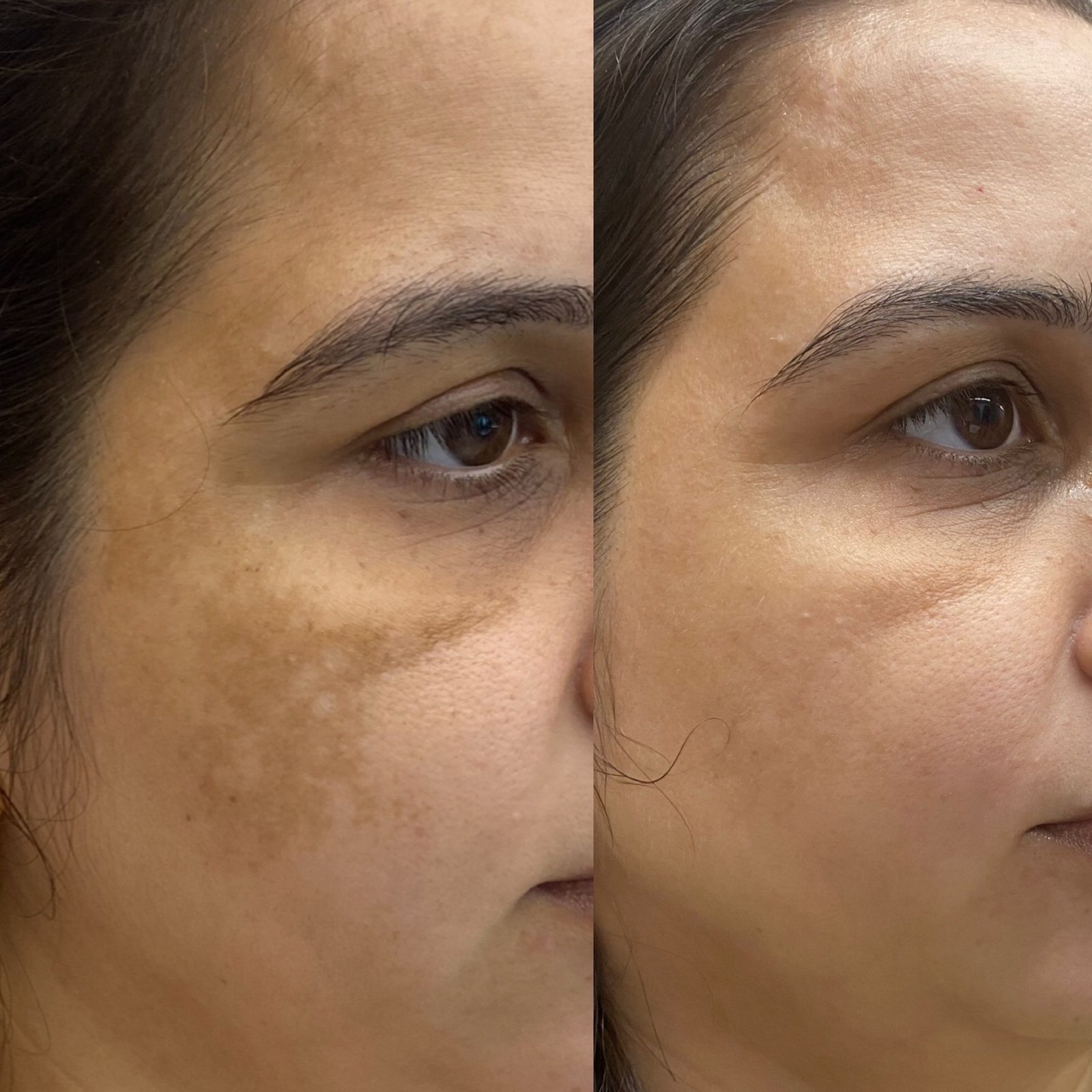 Melasma Therapy Results