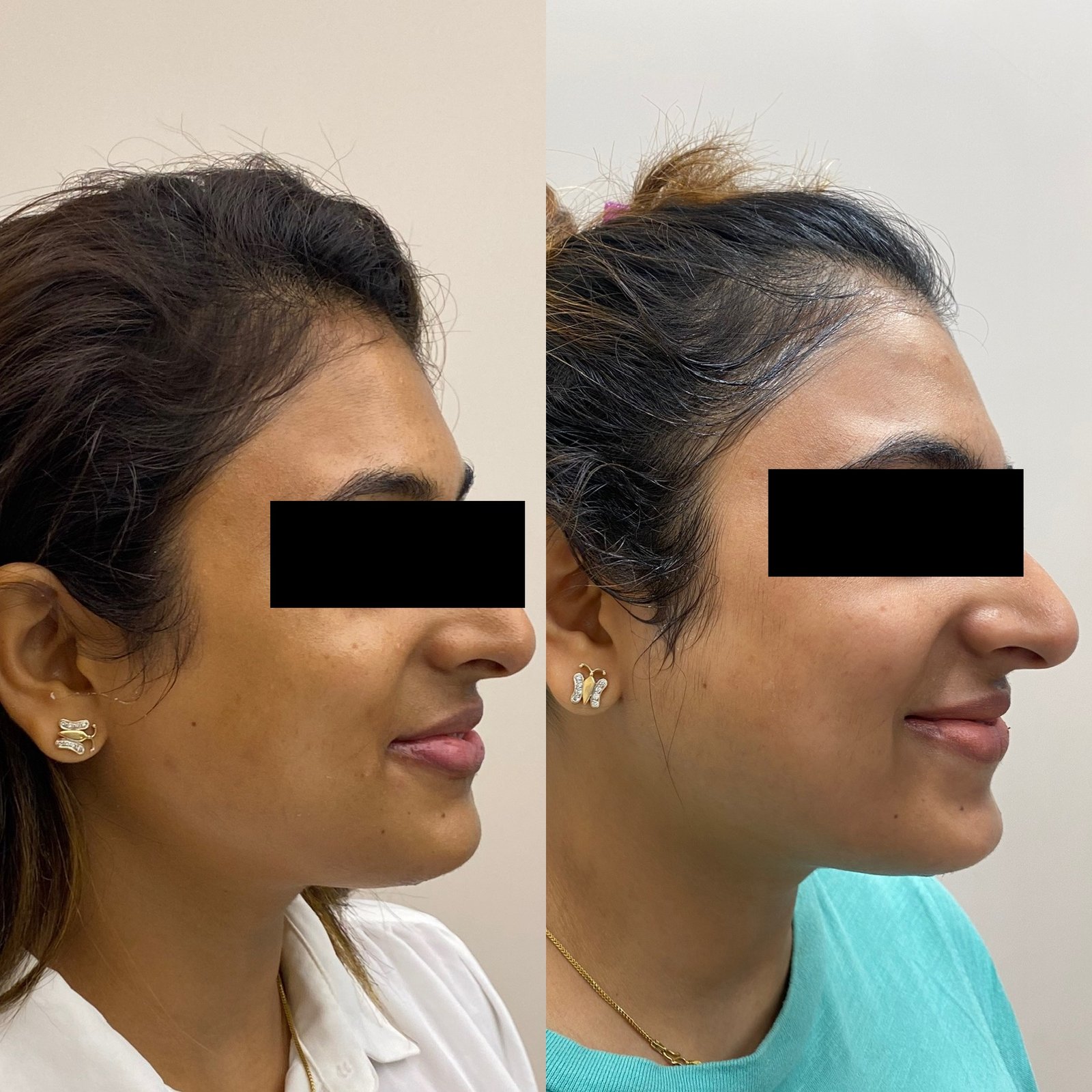 Pigmentation Correction