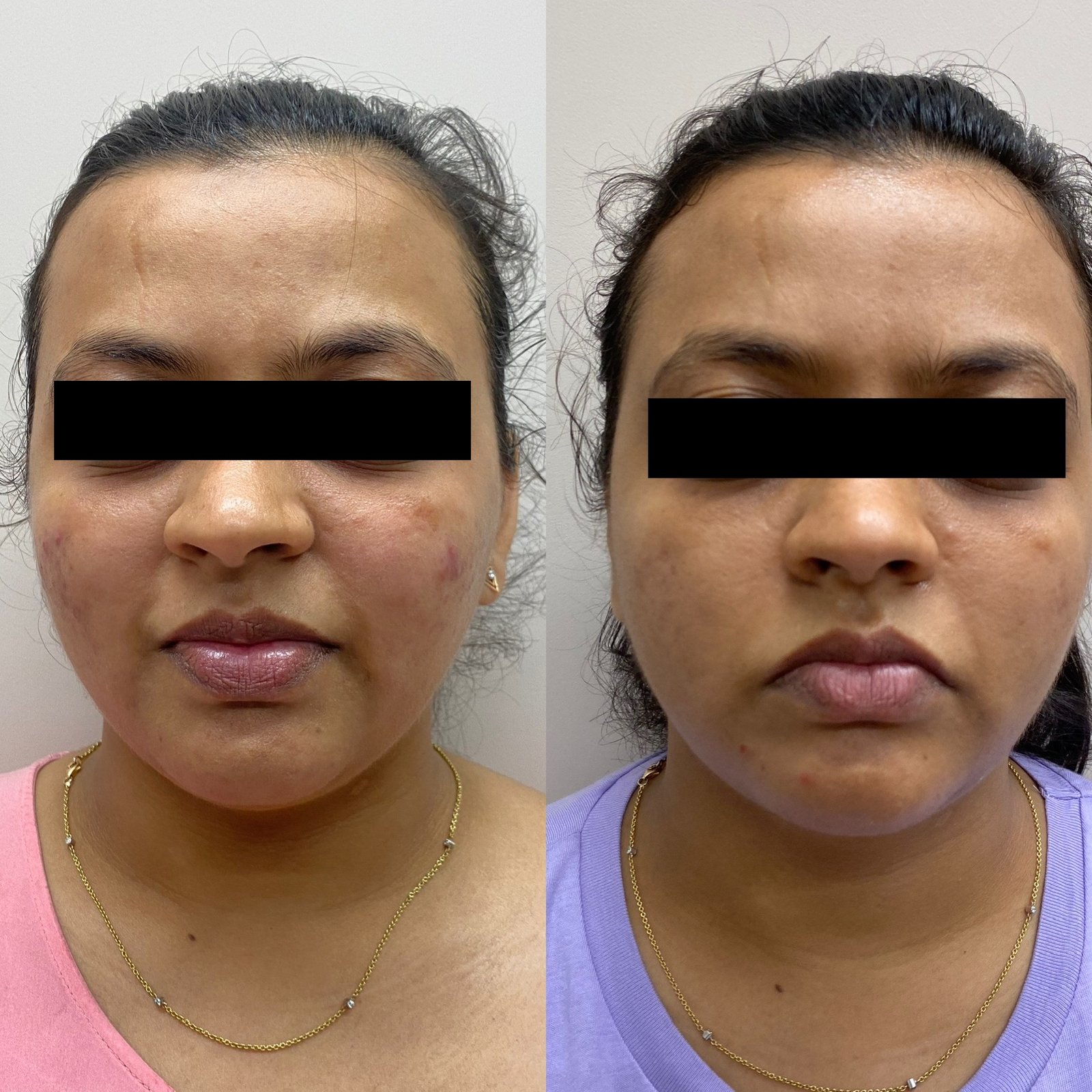 Surgical Scar Results