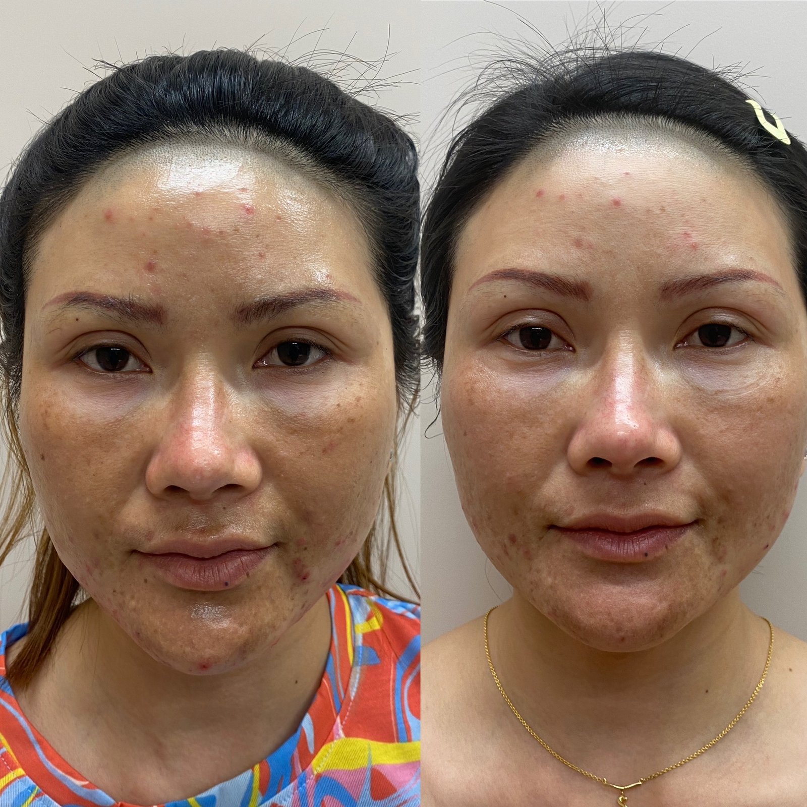 Volite Filler Treatment Results