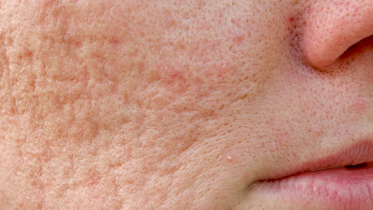 Understanding Different Types of Acne Scars