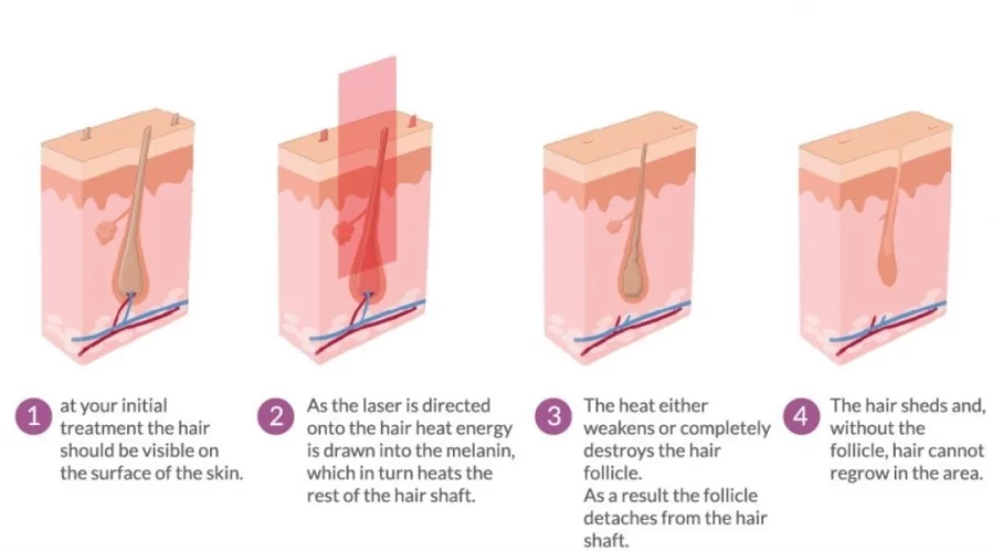 laser-hair-removal-image2